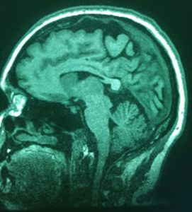 Mri scan of a human brain in sagittal section showing various brain structures including the cerebral cortex, cerebellum, and brainstem.